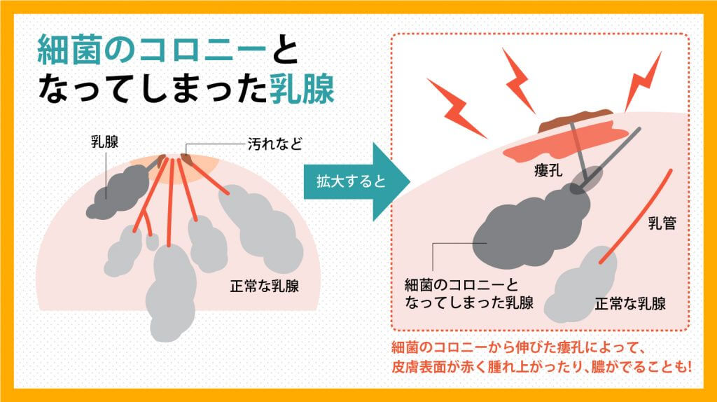 陥没乳首が原因で乳腺炎になるメカニズムと治療法について 陥没乳頭 陥没乳首 対策改善サイト