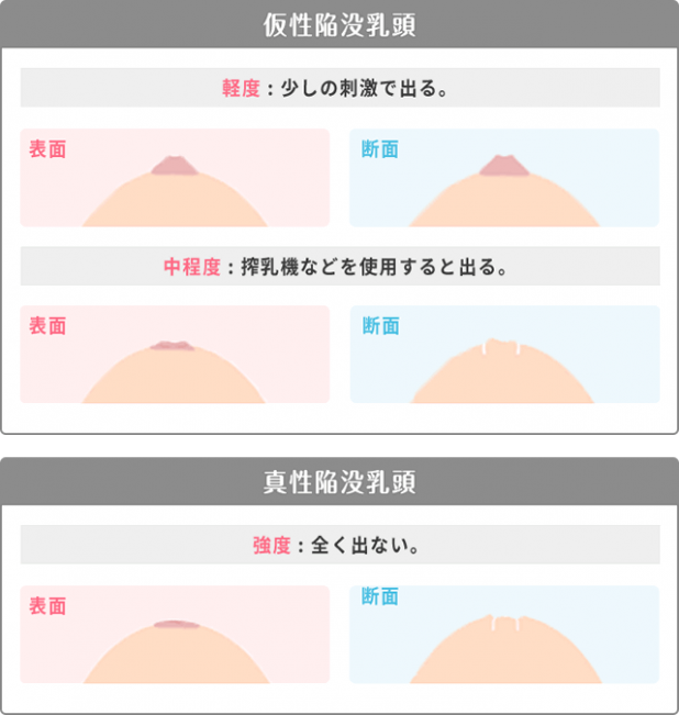 自力で簡単に陥没乳頭(陥没乳首)をマッサージで治す方法｜陥没乳頭（陥没乳首）対策改善サイト