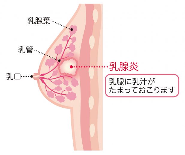 乳腺炎の原因