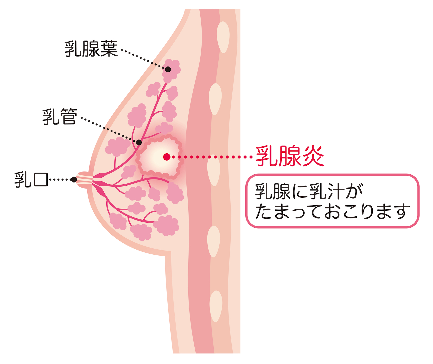 陥没乳首が原因で乳腺炎になるメカニズムと治療法について 陥没乳頭 陥没乳首 対策改善サイト